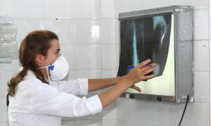 Leia mais sobre o artigo Tuberculose: Amazonas lidera incidência no Brasil, seguido por Roraima e Rio de Janeiro